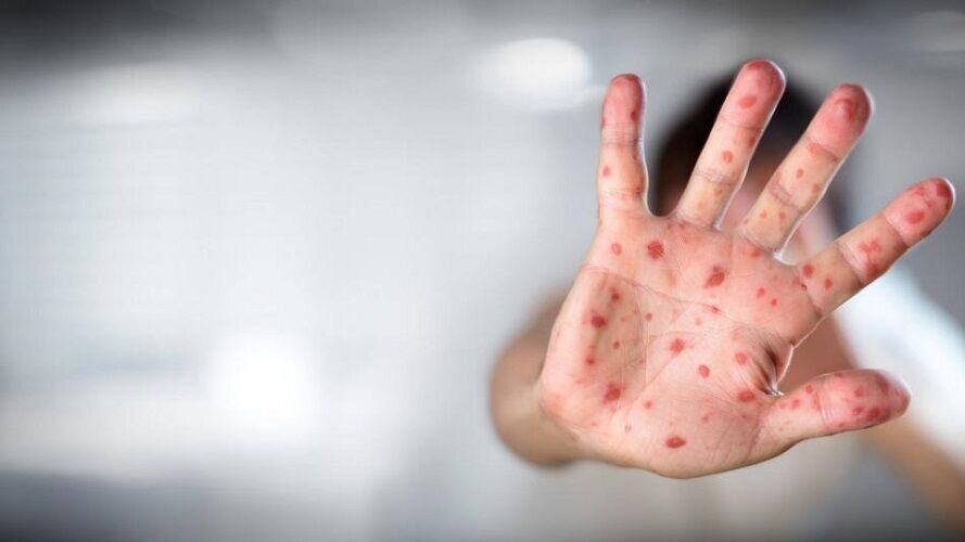 آبله میمون از طریق هوا منتقل میشود؟ آبله میمون از طریق هوا منتقل میشود؟